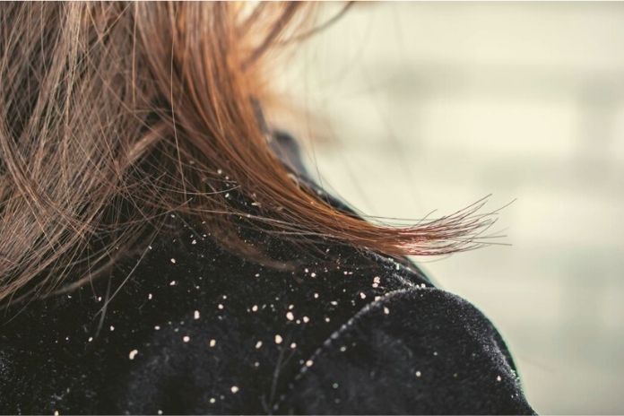 Dandruff How To Get Rid Of It, 7 Tips That Help!