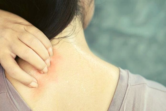 Get Rid Of Heat Rash These Tips And Home Remedies